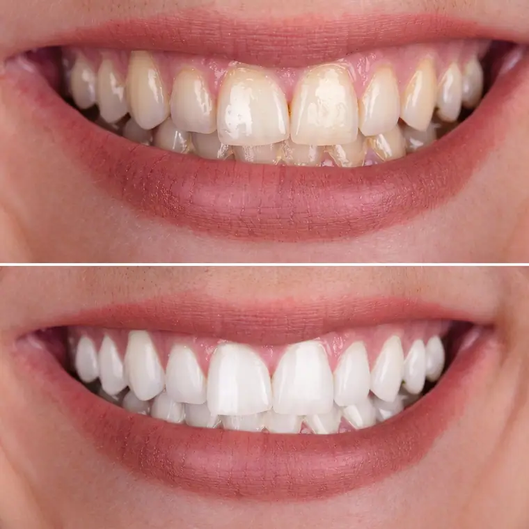 Antes e depois de clareamento dental, caso real de paciente da Potenza Odontologia