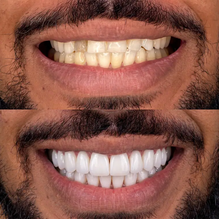 Antes e depois de facetas e lentes, caso real de paciente da Potenza Odontologia