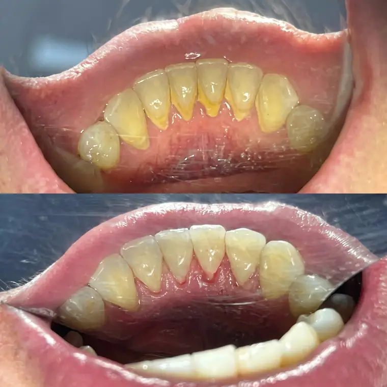 Antes e depois de limpeza dentária, caso real de paciente da Potenza Odontologia